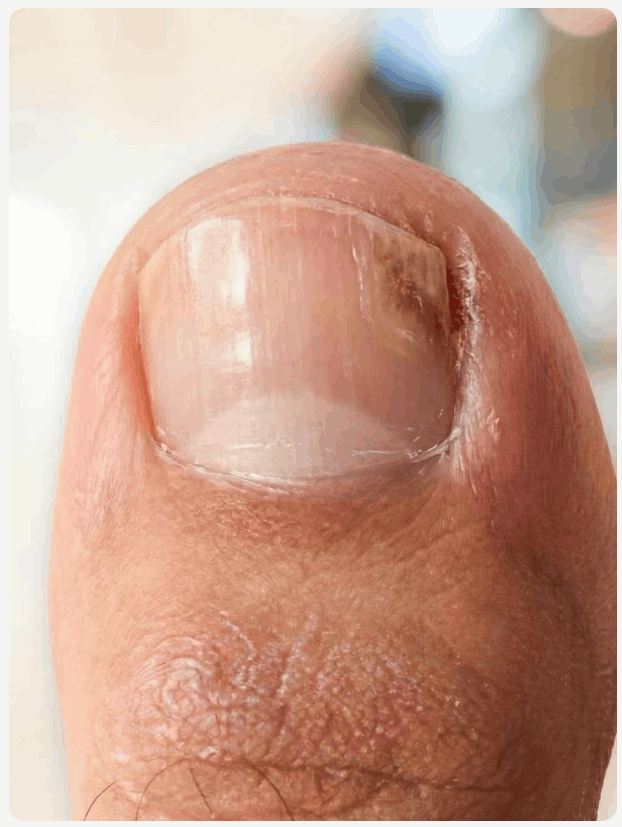 Orivelle Antifungal
